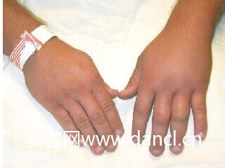 蜜蜂蛰了怎样消肿